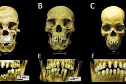 Skulls and dental decoration patterns for the three African individuals from the San José de los Naturales Royal Hospital
