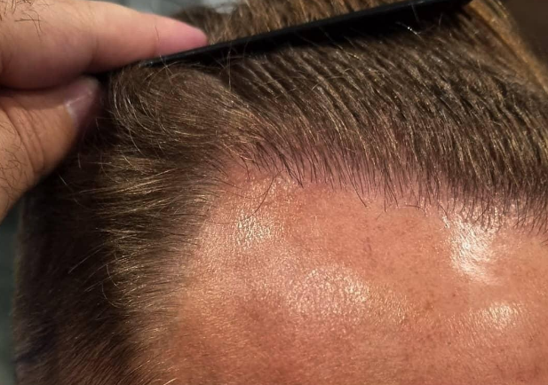 Hair Transplant Turkey Before and After: What you need to know