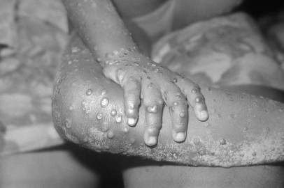 Monkeypox Vaccine for Children: Here's What Every Concerned Parent Should Know