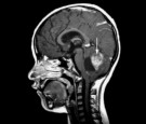 Brain Tumor Overview