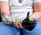 Nine Year Old Boy Is Fitted With A Bionic Arm