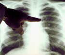 A view of a close up of a lung x-ray of a cigarette smoker in an undated photo