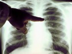 A view of a close up of a lung x-ray of a cigarette smoker in an undated photo