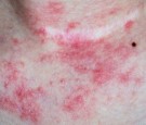 skin rashes