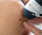 Effective Skin Tag and Mole Removal Methods