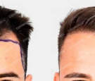 Hair Transplant Turkey Before and After: What you need to know