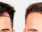 Hair Transplant Turkey Before and After: What you need to know