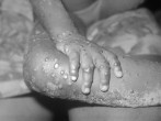 Monkeypox Vaccine for Children: Here's What Every Concerned Parent Should Know