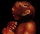 Anencephaly